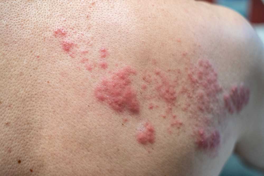 Cómo funcionan los tratamientos para dermatitis numular en Panamá