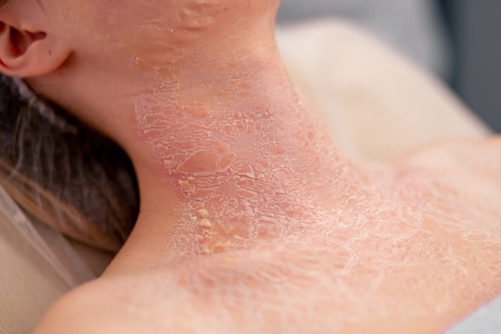 Todo sobre el Tratamiento de Dermatitis Numular en Panamá