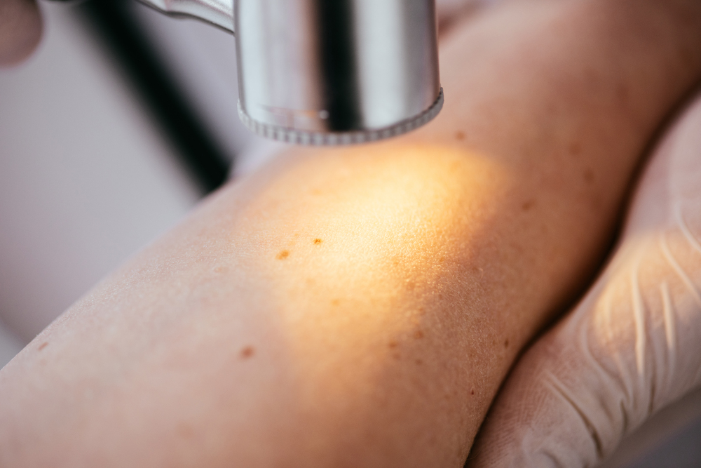 Recupera la Belleza de tu Piel Beneficios del Tratamiento de Punto Rubí