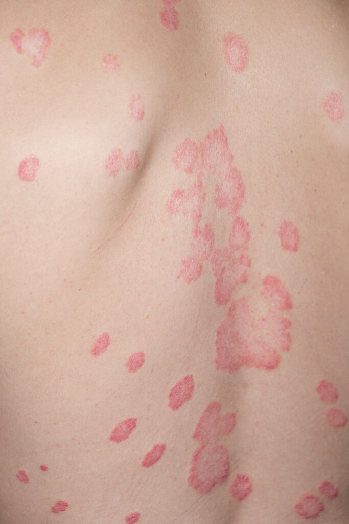 Todo lo que Necesitas Saber sobre el Tratamiento de Liquen Plano