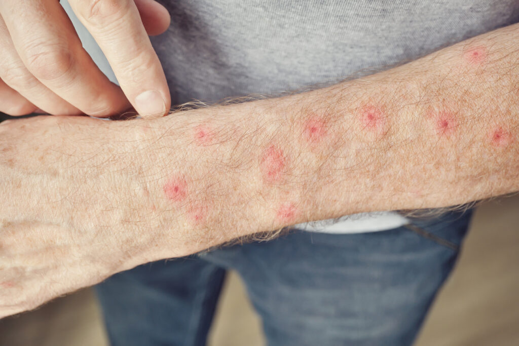 Tratamiento de Liquen Plano en Panamá