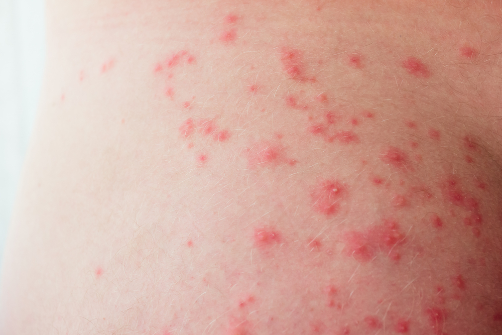 Un Enfoque Experto El Método del Centro DERMEC