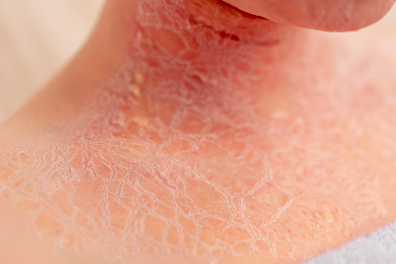 Enfermedades Autoinmunes de la Piel Más Frecuentes