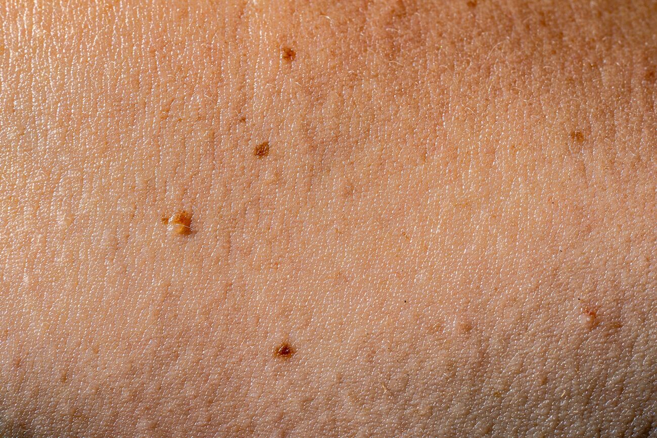 Cuándo no está indicado el Skin Tag Contraindicaciones