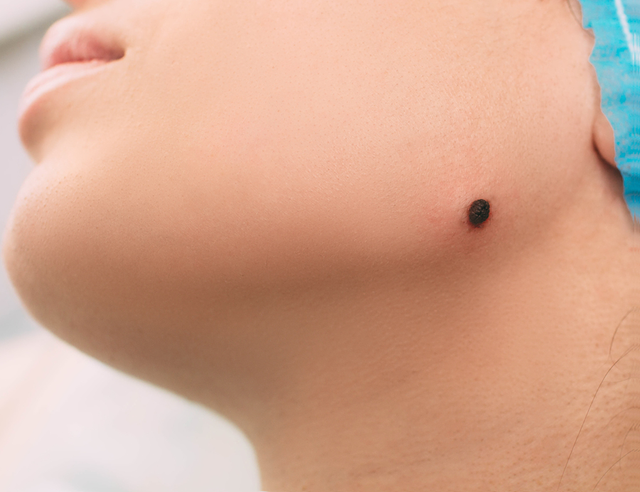 Diferencia entre acrocordones benignos y lesiones sospechosas