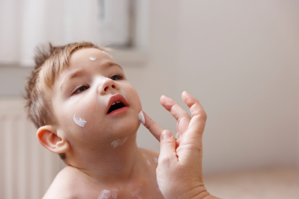 Errores en el Tratamiento de Dermatitis en Niños
