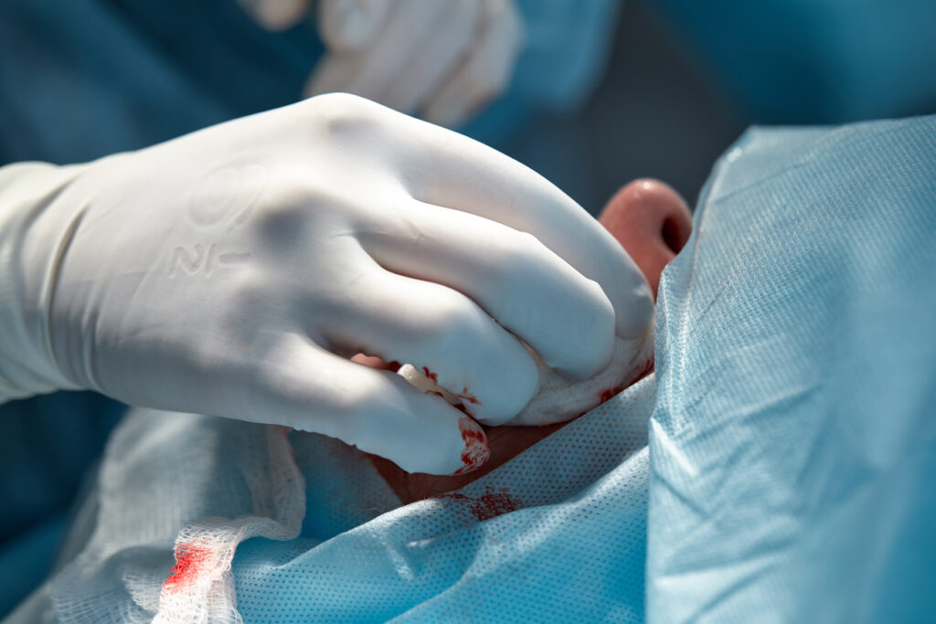 Preservación de tejido sano Mohs vs convencional