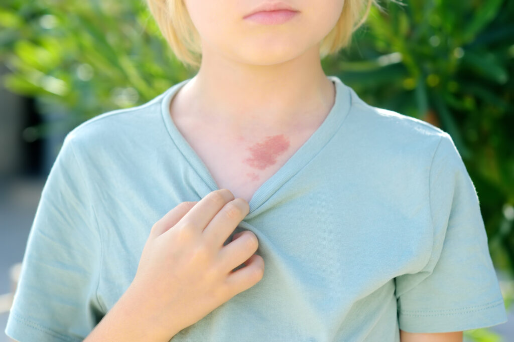 Síntomas Principales de la Dermatitis Atópica