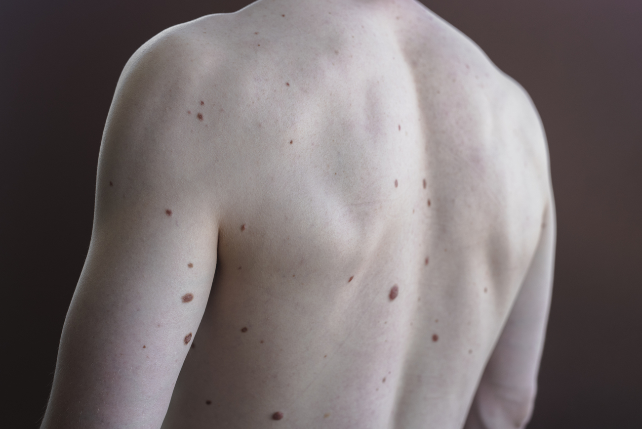 Mapeo digital de lunares quién debe hacerlo y frecuencia