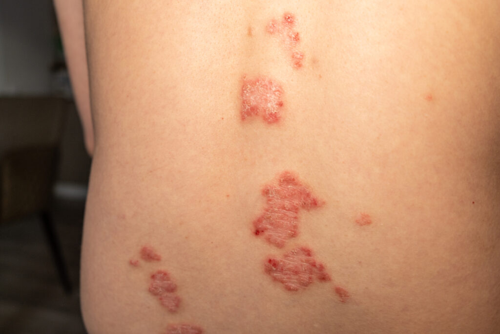 Tipos de psoriasis y sus presentaciones específicas