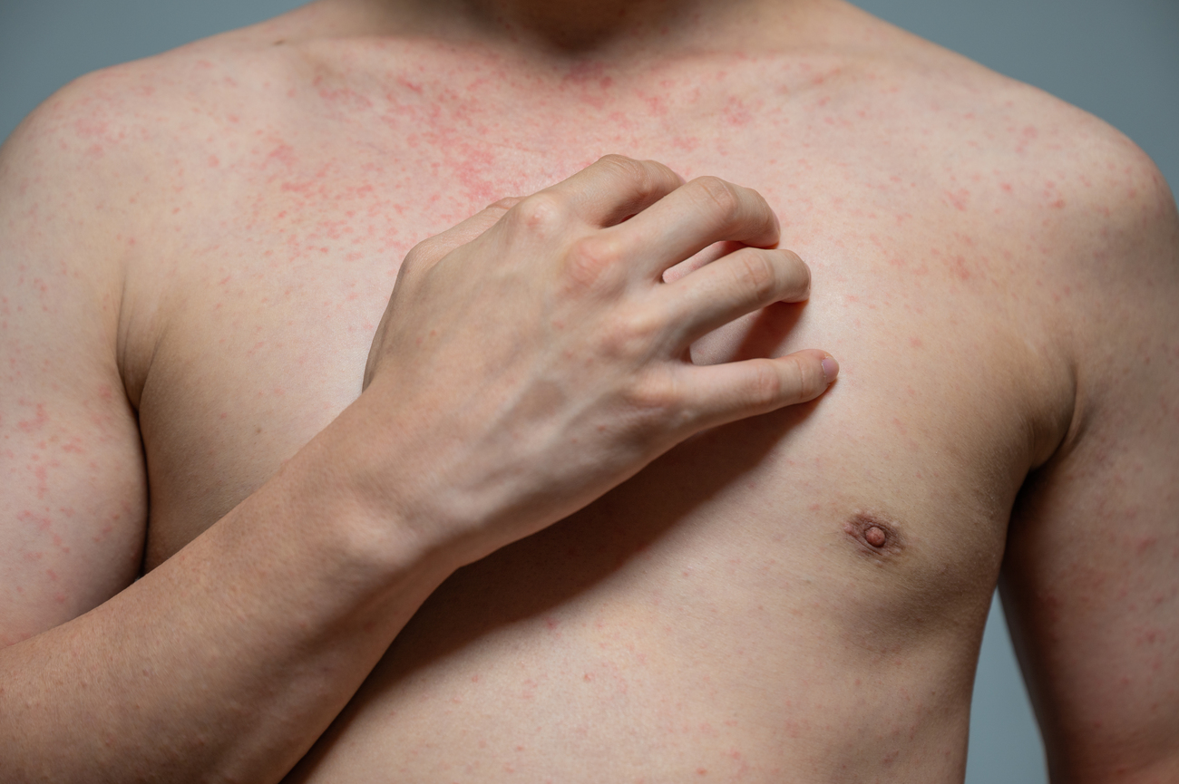 Dermatitis numular vs eccema atópico cómo diferenciarlos