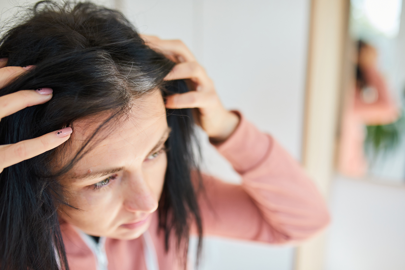 Dermatitis seborreica vs caspa señales para diferenciarlas