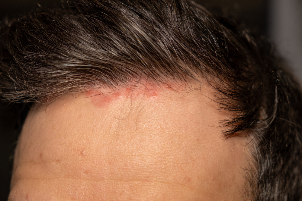 Diferencias con dermatitis atópica y otros diagnósticos