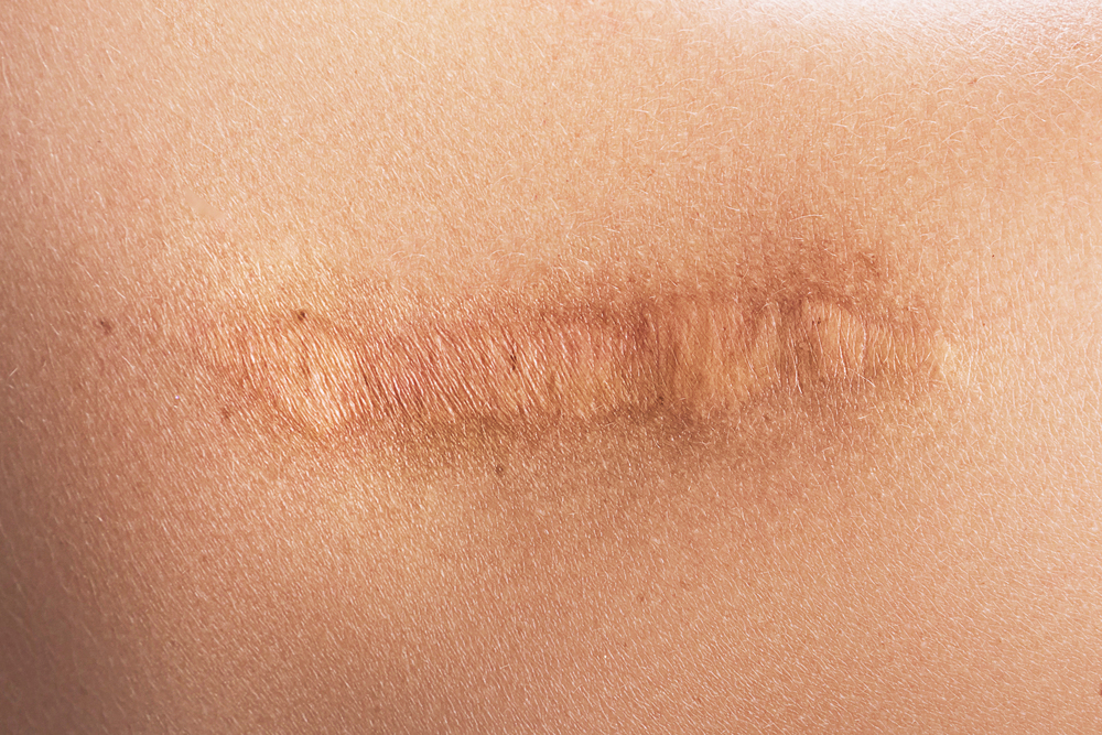 Queloides vs cicatrices hipertróficas por qué requieren tratamientos diferentes