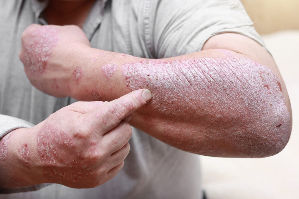 Zonas del cuerpo más afectadas por dermatitis numular
