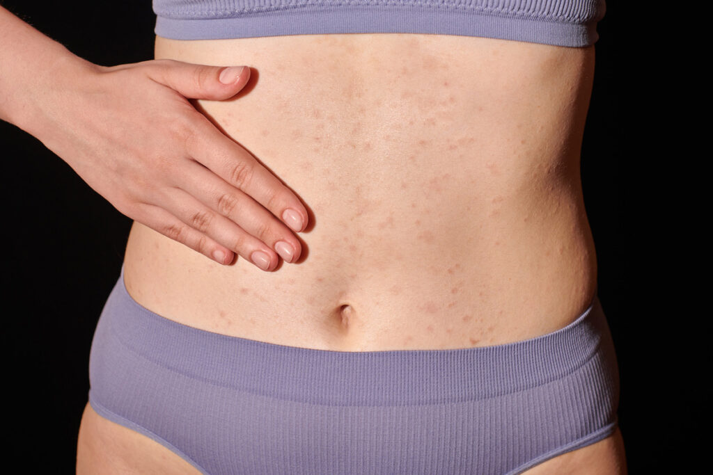 Acné corporal poros tapados e inflamación