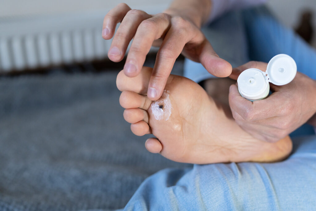 Cómo evitar contagiar verrugas en casa y prevenir su reaparición