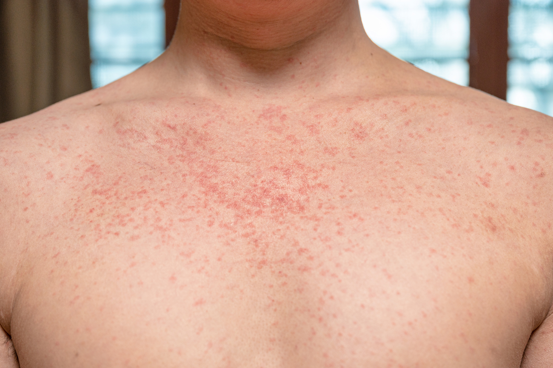 Dermatitis de Contacto Irritativa vs Alérgica Cómo Identificarlas Cuando la Piel se Enrojece o Arde