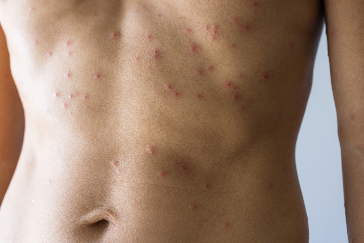 Foliculitis vs. Acné Corporal Claves para Distinguir Granitos Inflamados