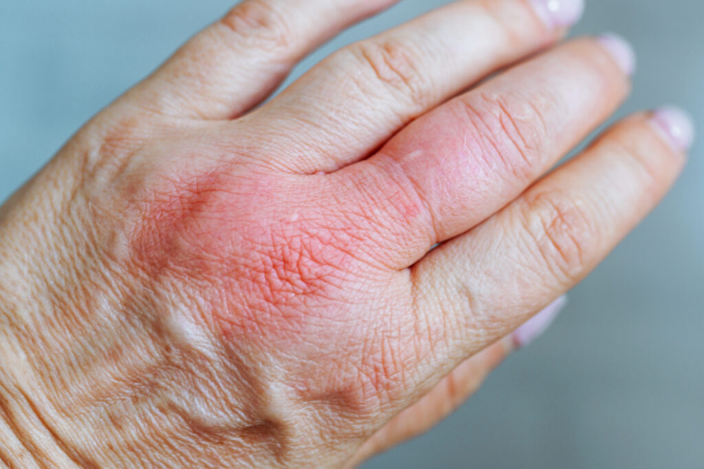 Tipos principales de dermatitis de contacto irritativa y alérgica