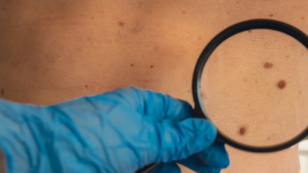 Señales de fricción dolor, sangrado o irritación persistente