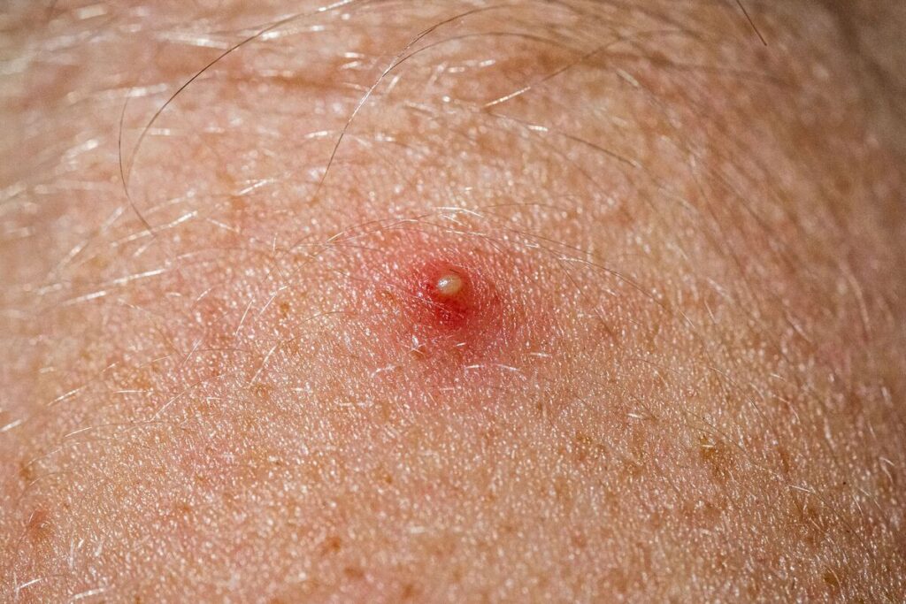 Señales iniciales de hidradenitis supurativa que conviene reconocer